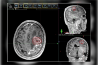 ESTIMULAÇÃO MAGNÉTICA TRANSCRANIANA