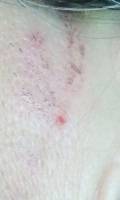 Doença de Morgellons em estágio inicial